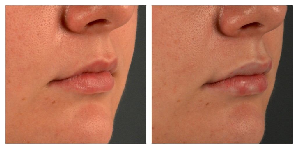 Olivia Frescura Restylane Silk Lip Injections Before and After Right